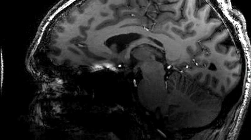 A real human brain scanned slice by slice on an MRI.